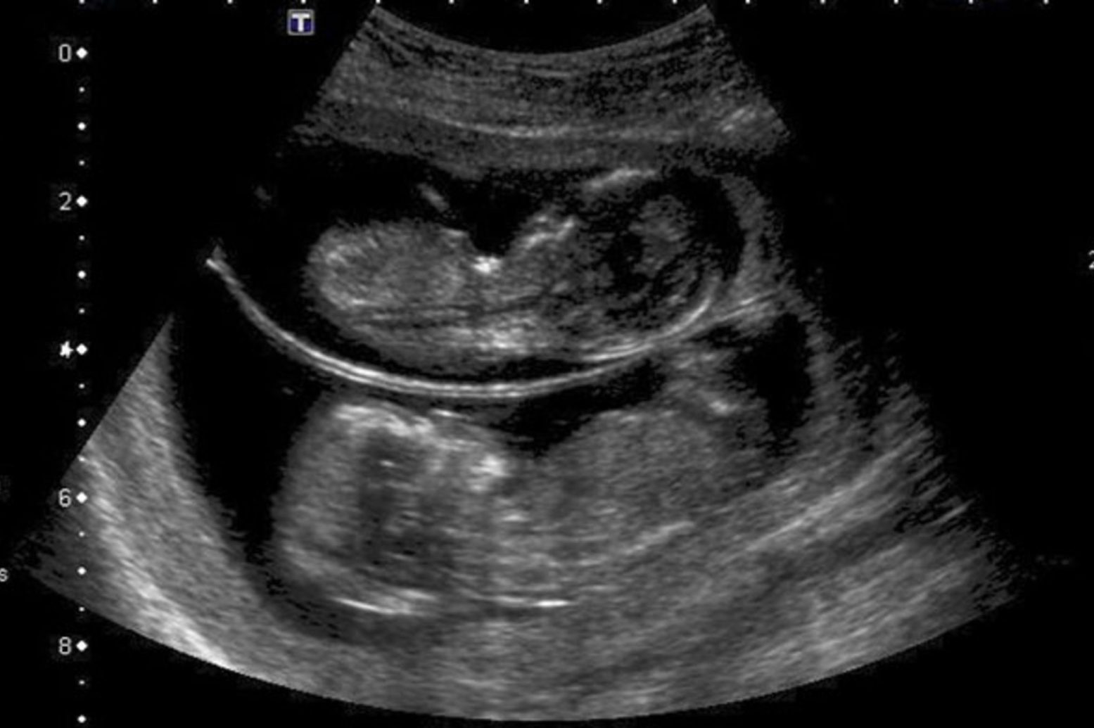 twin-ultrasound (4) twin-ultrasound (4)